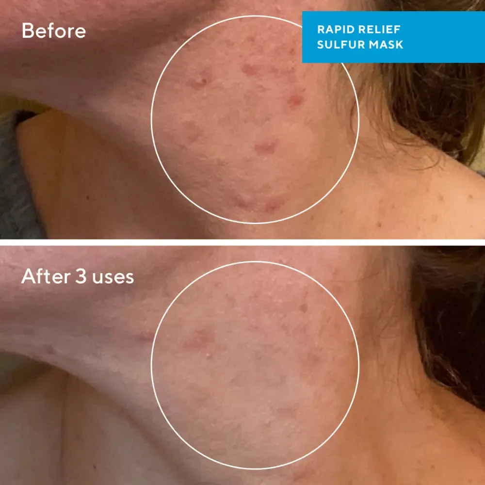 Murad Rapid Relief Sulfur Mask 74ml